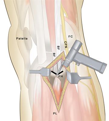Frontiers Partial Fibular Head Osteotomy is an Alternative